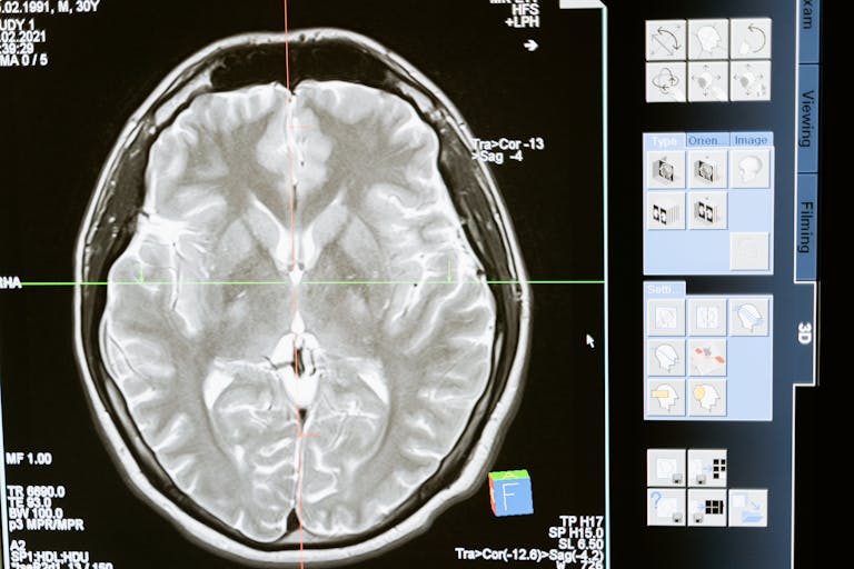 MRI brain scan showing the medical basis for concussion research and the limits of rugby scrum caps